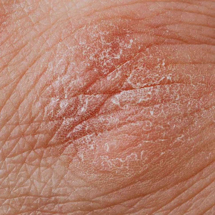 cover art for Breakthrough eczema technology 'could end misery for millions' | special