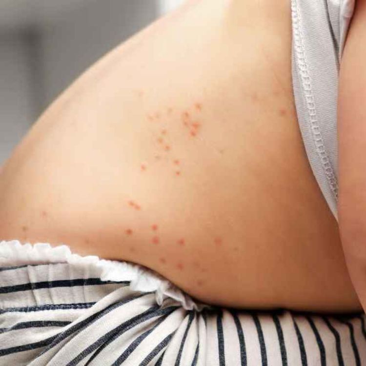 cover art for Chickenpox vaccine to be made available on NHS 