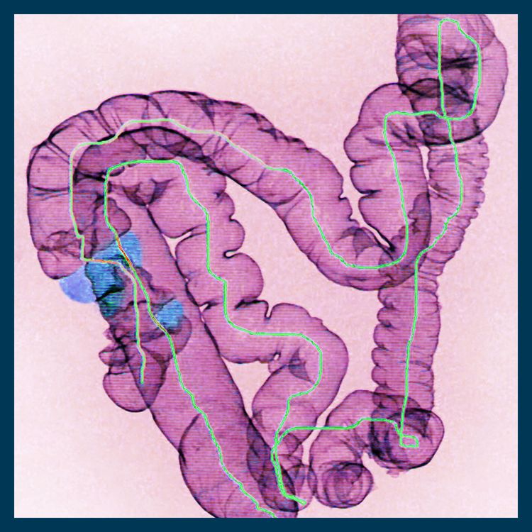 cover art for Why are more young people getting bowel cancer?