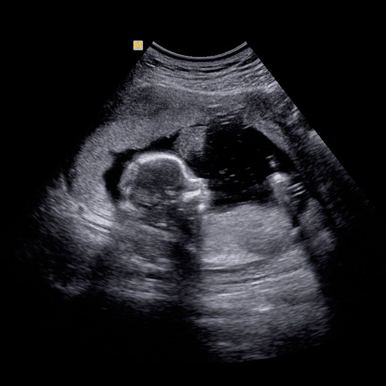 cover art for PRANK: Saoirse's Fake Pregnancy Post