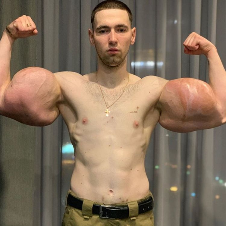 cover art for Russian Man Injects 3 Litres of Vaseline In Each Bicep