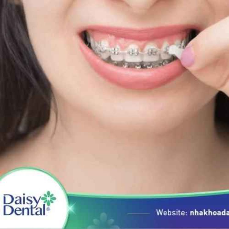 cover art for Sáp nha khoa là gì? Công dụng và cách sử dụng đúng cách