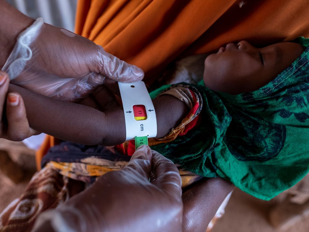 cover art for Más de 700 niños han muerto en los centros de nutrición de Somalia.