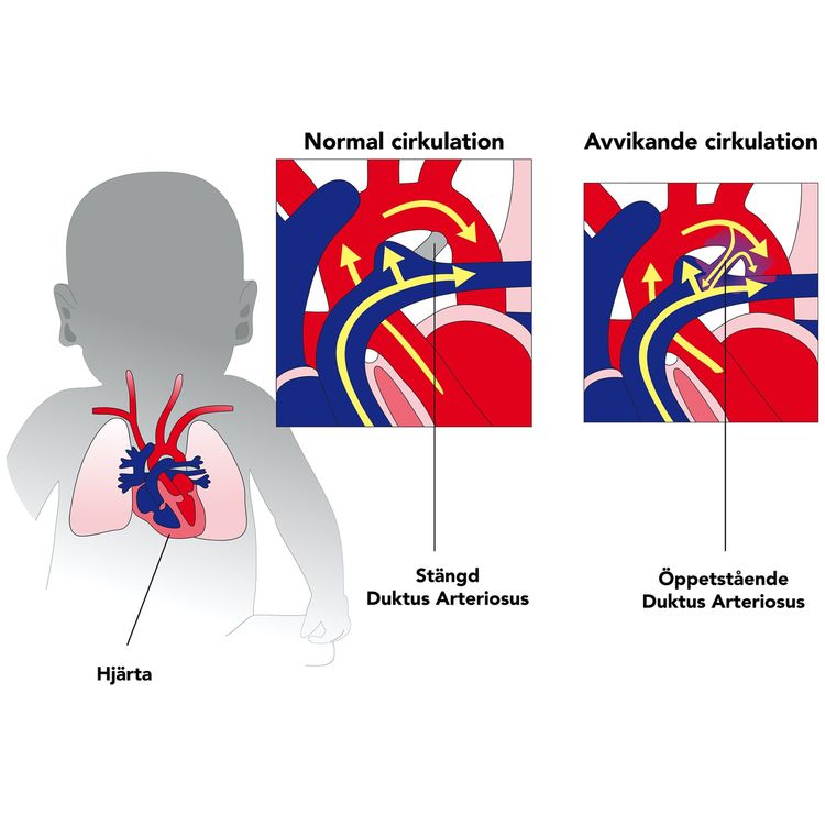 cover art for När fosterförbindelsen ”duktus arteriosus” står öppen