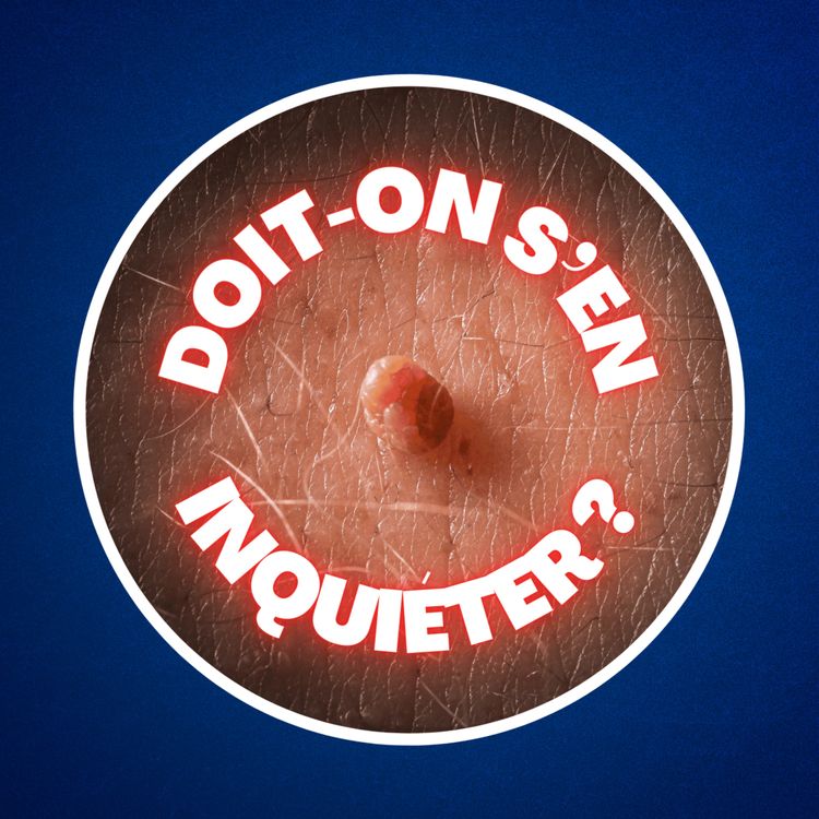 cover art for Qu'est-ce qu'un acrochordon ? (1 personne sur 2 en a sur le corps ! 😱)