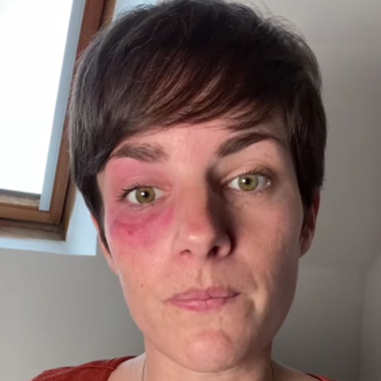 cover art for ATTEINTE D'ALGIE VASCULAIRE DE LA FACE, DIANE TÉMOIGNE