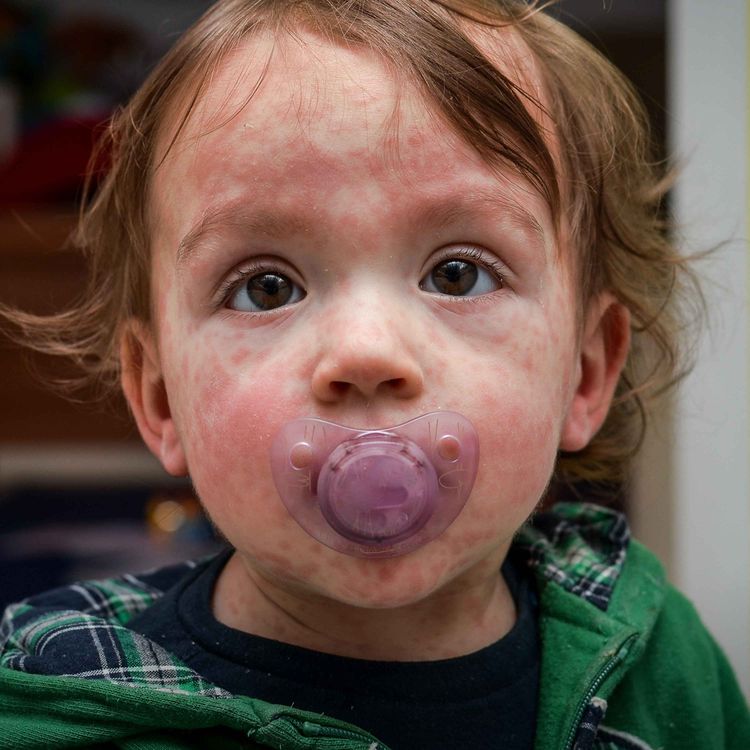 cover art for What's fueling a rise in measles cases in the UK? 
