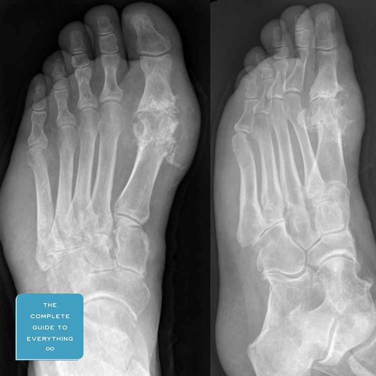cover art for Getting Gout