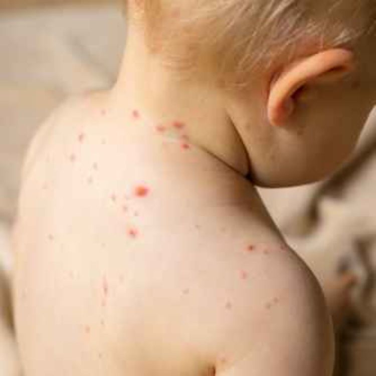 cover art for Ep. 60 - La barna få vannkopper eller vaksinere?